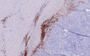 T-Zellen (braun) infiltrieren Lebermetastasen (blau). Quelle: DKFZ/Dirk Jäger